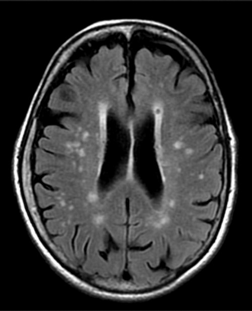 A magnetic resonance imaging of the brain showing multiple bright white spots in the tissues of the brain.photo