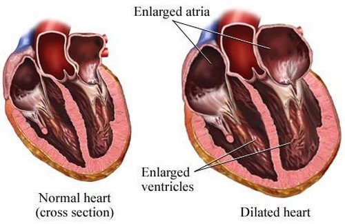 A normal heart and a heart with dilated cardiomyopathy. The ventricles are thin and enlarged (overly stretched.pictures