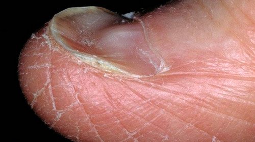 A patient with koilonychia. The nail looks like it is scooped out and the surrounding tissues are dry.pictures