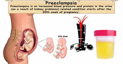 A sample urine of a pregnant women with preeclampsia.photo