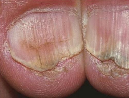 A severe form of koilonychia wherein the outer edges are crusted and the surrounding tissues are severely dry. There is also discoloration of the nails. image