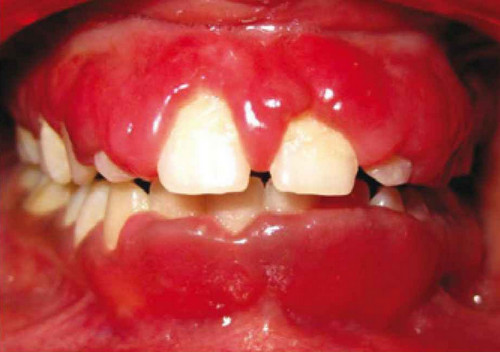 A severe swelling of the gums.image