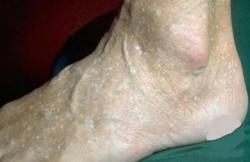 A stucco keratosis on the foot of an elderly patient.photo