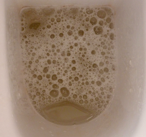 A urine full of bubbles, which is an indicator of a serious underlying health condition.photo