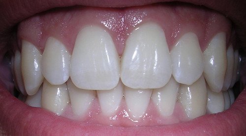 An image of a normal healthy gums.photo