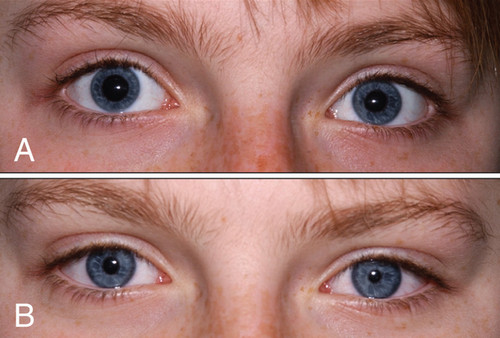 Image A showing dilated pupils and image B showing bilateral pinpoint pupils.picture
