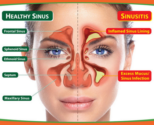 Inflammation of the sinus, one of the culprits for pain on top of the head.photo
