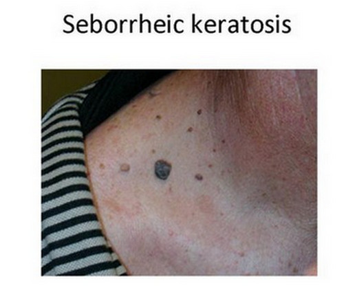 Seborrheic keratosis or melanoma in an elderly patient.image