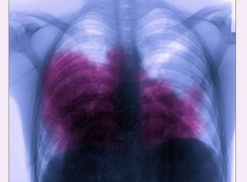 A close up view of the lungs of the patient with acute bilateral pneumonia caused by Legionnaire’s disease pictures