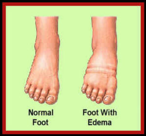 HealthoolA comparison image between a normal foot and a foot with edema