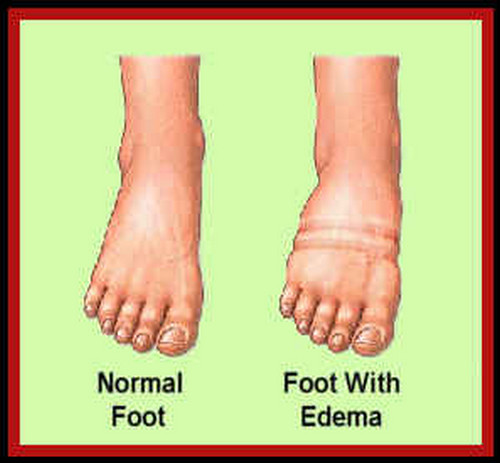 A comparison image between a normal foot and a foot with edema pictures