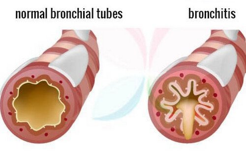 A comparison image between a normal healthy bronchial tubes and an inflamed bronchial tube pictures