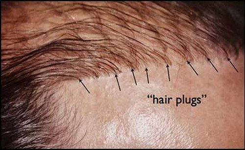 What are Hair Plugs - Costs, before and after, how much do cost and