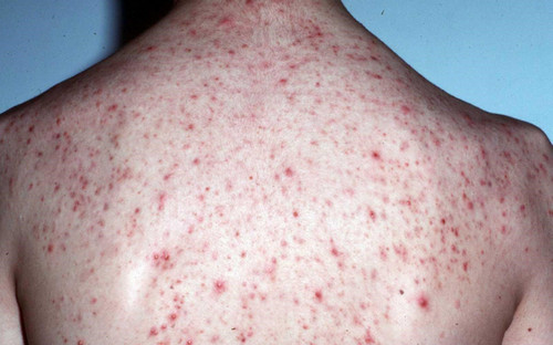 A patient with severe pityrosporum folliculitis at the back image