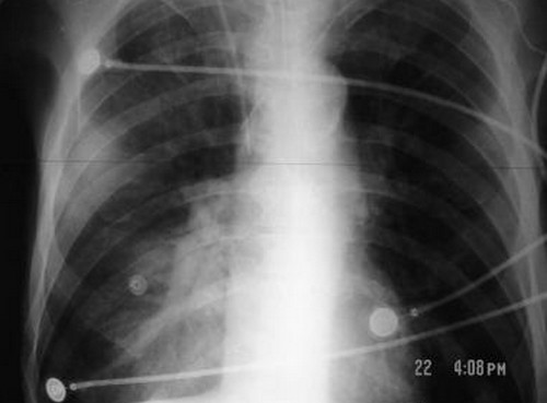 An x-ray of the lungs infected with bilateral pneumonia photo