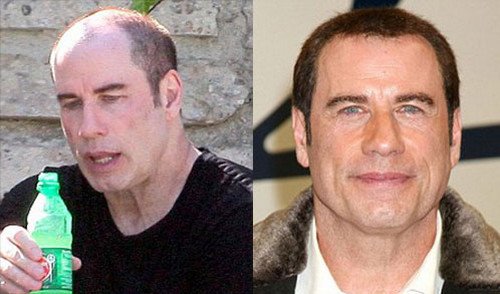 Before and after hair transplant methods of John Travolta image