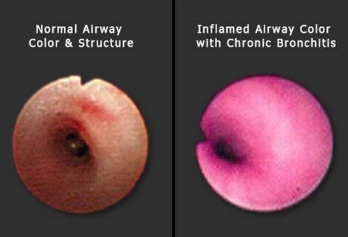 Bronchitis pictures