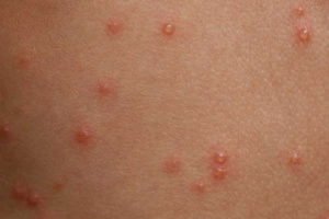 HealthoolChicken pox (Varicella zoster virus (VZV) infection) Rash ...