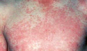 HealthoolDengue fever Rash Pictures Atlas of Rashes Associated With ...