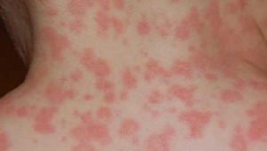 HealthoolDrug reactions Rash Pictures Atlas of Rashes Associated With ...