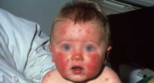 Healthoolerythema Infectiosum Fifth Disease Rash Pictures Atlas Of
