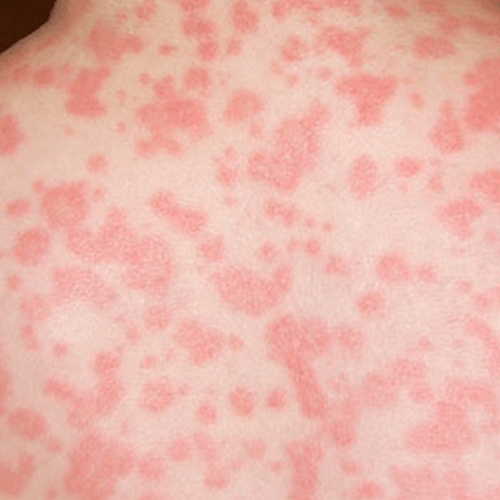 Healthoolfish Allergy Rash Pictures Atlas Of Rashes Associated With