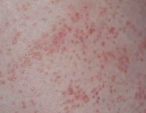 HealthoolHeat Rashes Pictures Atlas of Rashes Associated With Fever ...