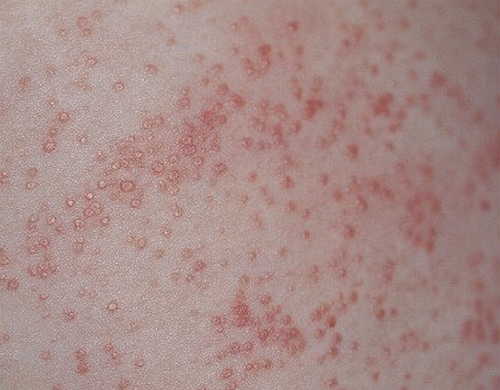 Healthoolheat Rashes Pictures Atlas Of Rashes Associated With Fever