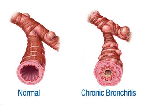 chronic bronchitis lung sounds