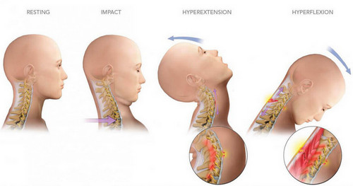Images showing how a simple whiplash can cause neck pain pictures