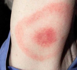 HealthoolLyme disease Rash Pictures Atlas of Rashes Associated With ...