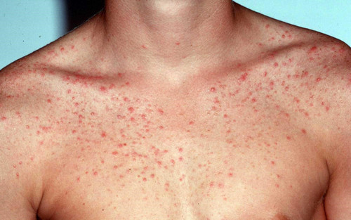 Pityrosporum folliculitis rash on a patient’s chest and shoulder areas pictures