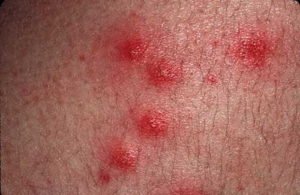 HealthoolPseudomonas “Hot-Tub” Folliculitis Rash Pictures Atlas of ...