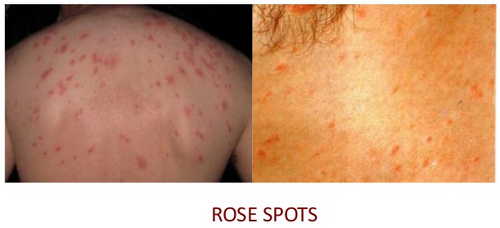 Healthooltyphoid Fever Rash Pictures Atlas Of Rashes Associated With
