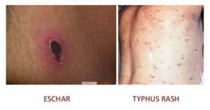 HealthoolTyphus Fever Rash Pictures Atlas of Rashes Associated With