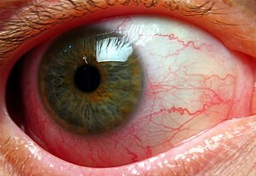 A close up view of the patient’s eye infected with iridocyclitis image photo picture