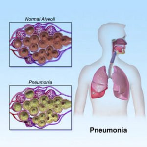 👉 Is Pneumonia Contagious ? (January 2022)