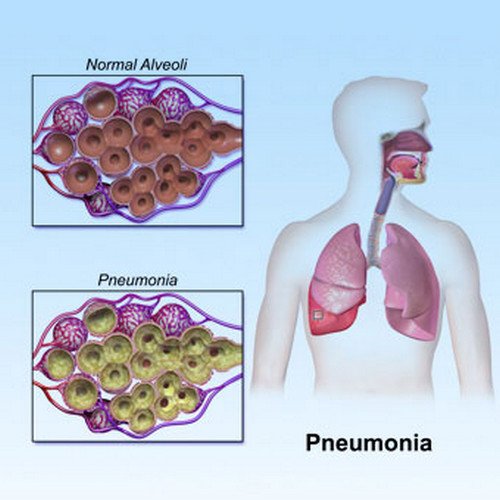 A normal alveoli and an alveoli with pneumonia Image