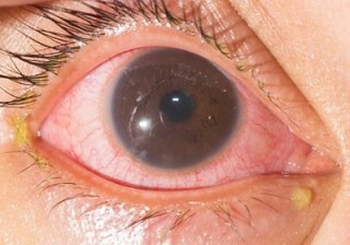 A patient with clinical manifestations of iridocyclitis The eye is red and swollen picture image photo