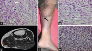 HealthoolA primary tumor categorized as intermediate grade spindle cell