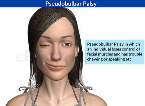 A typical clinical manifestation of a patient with bulbar palsy image photo picture
