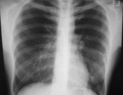 An x-ray image of a patient with bacterial pneumonia photo