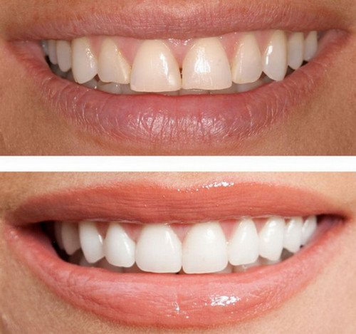 Before and after porcelain veneer Porcelain Braces porcelain brace image photo picture