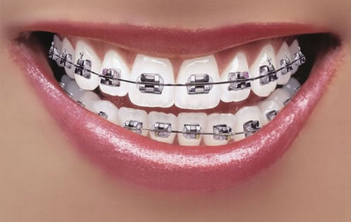Metal braces, one of the commonly used braces today Porcelain Braces image picture photo