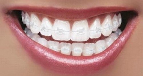 Porcelain braces have the same color as the teeth making them less visible picture photo image