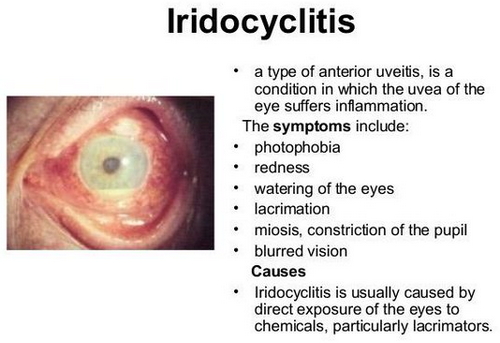 The classic symptoms of iridocyclitis image picture photo