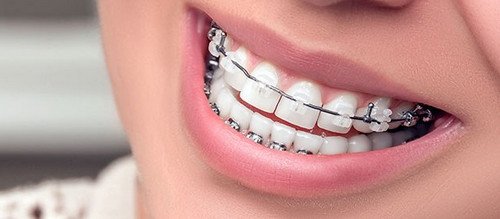 The patient has a porcelain brace on the upper teeth and metal brace on the lower teeth. A metal wire is attached to the brackets image picture photo