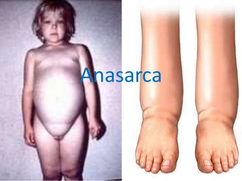 A child with generalized body swelling (anasarca) The legs, feet, face, and abdomen are bloated image photo picture