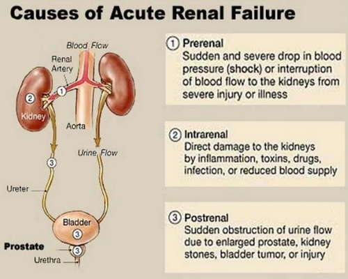A kidney-related disease affects the kidney’s ability to excrete urine leading to fluid retention image photo picture