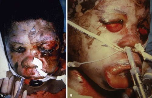 Generalized swelling is most likely to occur in burn patients secondary to fluid shift image photo picture